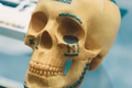 Metal Implants for Facial Surgery repair part, Medical titanium alloys for secure fractured bones - PhotoDune Item for Sale