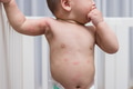 Toddler with red rash showing on skin - PhotoDune Item for Sale
